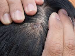 boils on scalp causes symptoms and