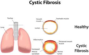 Cystic Fibrosis Genetics Home Reference Nih