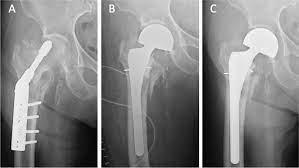 primary stem in hip arthroplasty