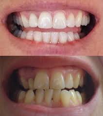 In fact, the condition also affects the overall. Invisalign Reddit Before After I Finished My Invisalign Treatment Now What