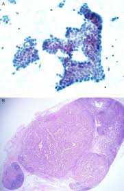 Fine needle aspiration cytology for thyroid is also useful to doctors. Lowered Cutoff Of Lymph Node Fine Needle Aspiration Thyroglobulin In Thyroid Cancer Patients With Serum Anti Thyroglobulin Antibody In European Journal Of Endocrinology Volume 173 Issue 4 2015