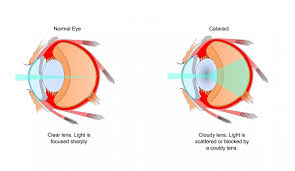 cataracts and intraocular lenses eye