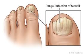 fungal nail infection video image