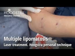 multiple lipomatosis laser treatment