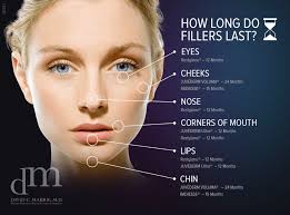 A wide variety of filler for face options are available to you, such as form, supply type, and ingredient. Longevity Of Dermal Fillers Guide San Francisco Dr David C Mabrie