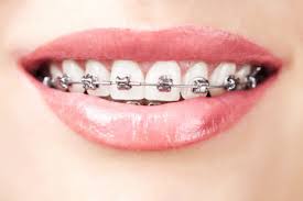 Average Cost Of Braces How Much Do Braces Cost