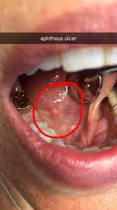 aphthous ulcer canker sore dr gentry