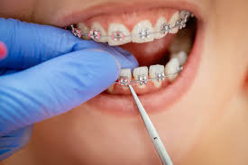 Decay can affect the shape of your tooth, causing the other teeth around it to shift. Can I Get Braces If I Have Missing Teeth Norlane Dental Surgery