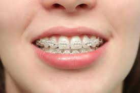 Instead of making them at home, some teenagers purchase fake dental braces raise quite a lot of alarms when it comes to health issues. How To Make Fake Braces Diy Fake Braces At Home Howto
