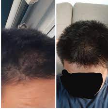 Since then it has worsened dramatically and has caused me some serious stress. I M A 16 Year Old Male I M Pretty Sure I M Balding But I Don T Really Understand Why Nobody In My Family Has Experienced This At Such A Young Age Hairloss