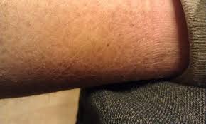 Image result for surface dehydration on black skin