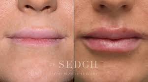 west hollywood lip filler injections
