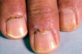 nail involvement in lupus erythematosus