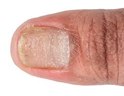 nail psoriasis symptoms causes