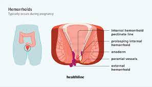 pregnancy hemorrhoids causes risks