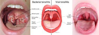 tonsil hypertrophy