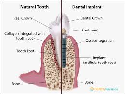 Free dental implants for low income uk. Cheap Dental Implants Abroad Affordable Safe High Quality