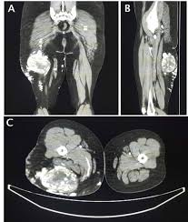 Muscle anatomy of upper thigh, human muscles, muscle anatomy of upper thigh. Cureus A Rare Case Of Hemangioendothelioma Of Upper Thigh