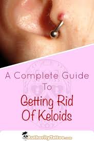 Everything You Need To Know About Getting Rid Of Keloids