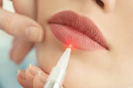 laser lip enhancement best lip