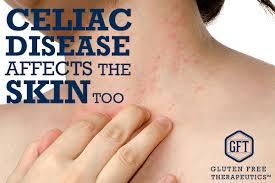 skin rash celiac disease gluten free