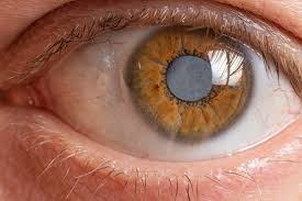 cataract surgery both eyes on the same