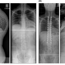 123rf.com.one particular type of kyphosis is. 25 Year Old Male With Advanced Symptomatic Scheuermann Kyphosis Download Scientific Diagram
