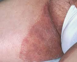 It may affect both women and men and occur on the buttocks although jock itch is not a severe medical condition, it may be very embarrassing and uncomfortable. Jock Itch Causes Of Jock Itch In Women Or Female Treatment