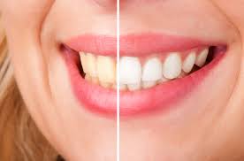 what is the best teeth whitening method