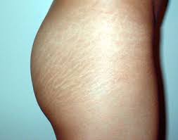 what causes white stretch marks