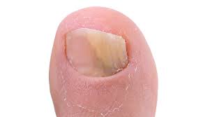 nail fungus skin conditions cal