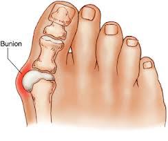 Image result for bunions