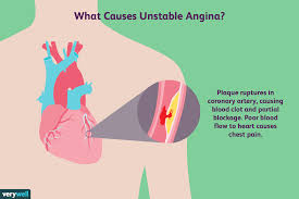 And what are the key angina pectoris or in short angina is used to describe a syndrome of retrosternal chest discomfort caused by in our fifth video, we provide examples of ua/nstemi on ecg. Unstable Angina Overview And More