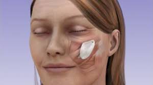 Injuries, infections, and underlying health issues can all cause swelling in one or both cheeks. Cheek Enhancement London Cheek Implant Uk Lbps
