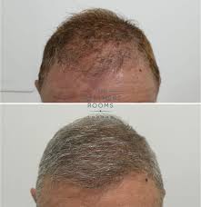 my hair after hair transplant surgery