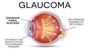 The basis for healthcare in many countries is for patients to look for medical care when they are symptomatic, however this approach has several problems: Glaucoma Protection With Iris Iristech