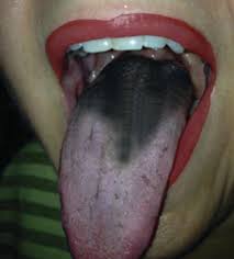 tongue discoloration springerlink