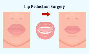 lip reduction surgery cost in hyderabad