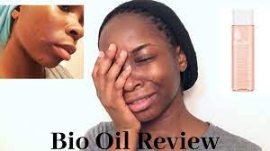 There's plenty of research to back up how great it is for complexion imperfections, too. Bio Oil Review For Skin I Want My Face Back Youtube