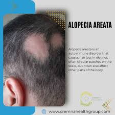 alopecia areata causes and treatments