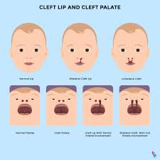 is cleft lip genetic facts about cleft