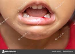 child bleeding lip close baby herpes
