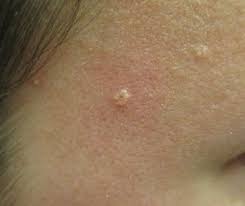 sebaceous hyperplasia removal cardiff