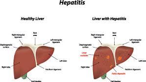Overview of hepatitis b virus mutations and their implications in the management of 34. Hepatitis Ursachen Symptome Behandlung Medlexi De