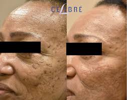 laser resurfacing cost