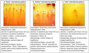 nailfold capillaroscopy sciencedirect