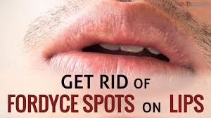 get rid of fordyce spots on lips