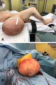 giant gluteal lipoma surgical