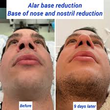 alar base reduction nostril reduction