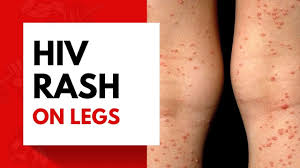 hiv rash on legs you